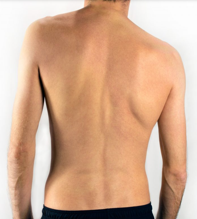 Scoliosis, the Silent Culprit 2 Scoliosis 2