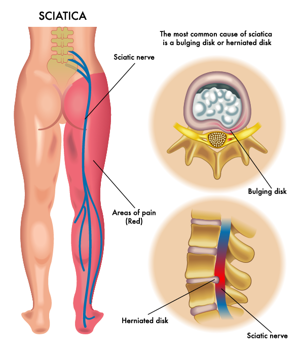sciatica sciatica symptom and causes malaysia