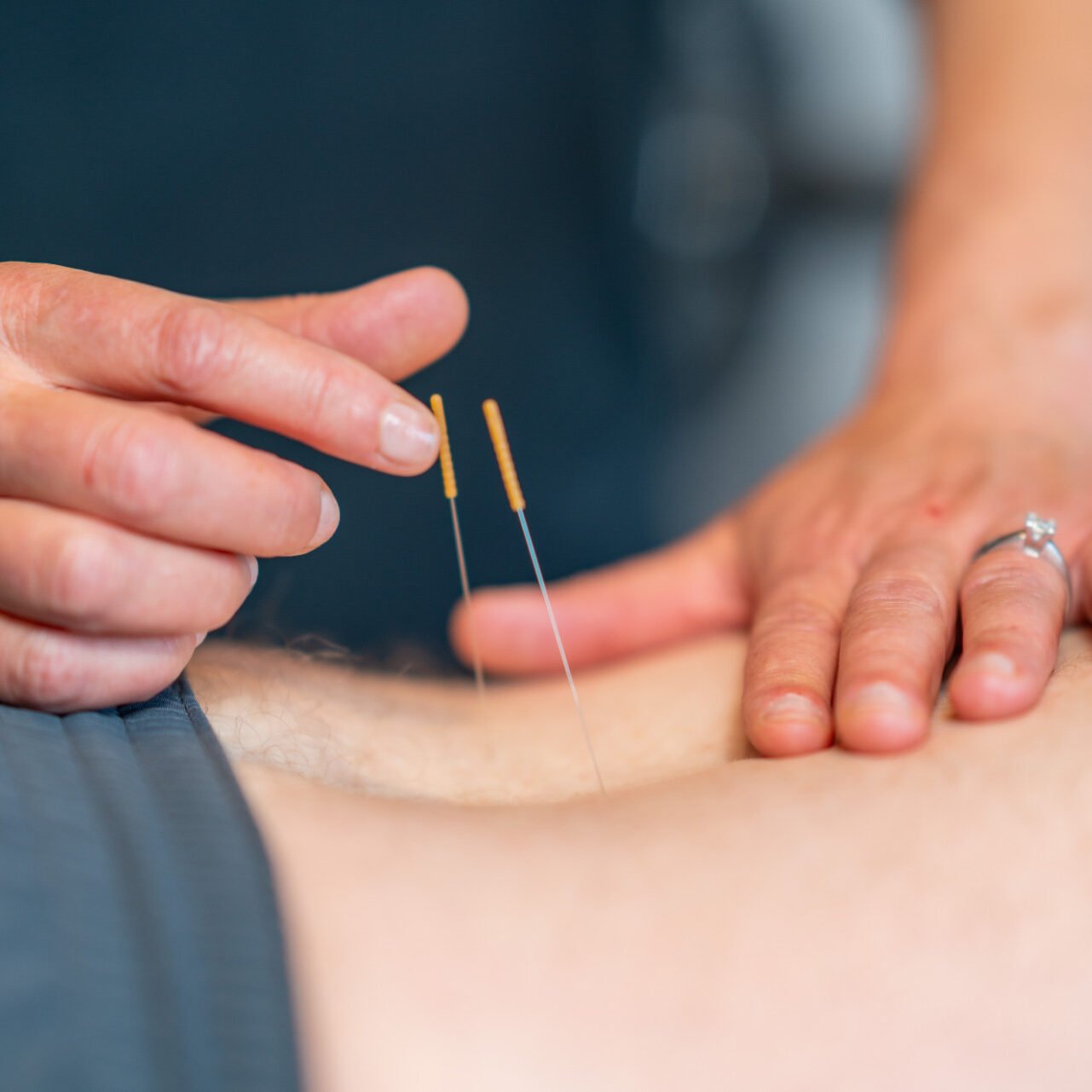 dry-needling-2